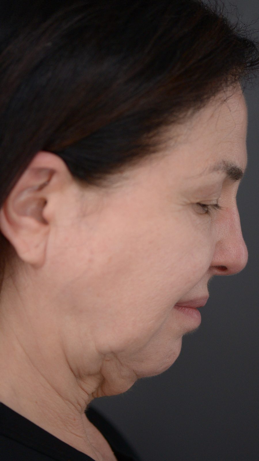 Ponytail Facelift before and after, case 02, view 3 (before)