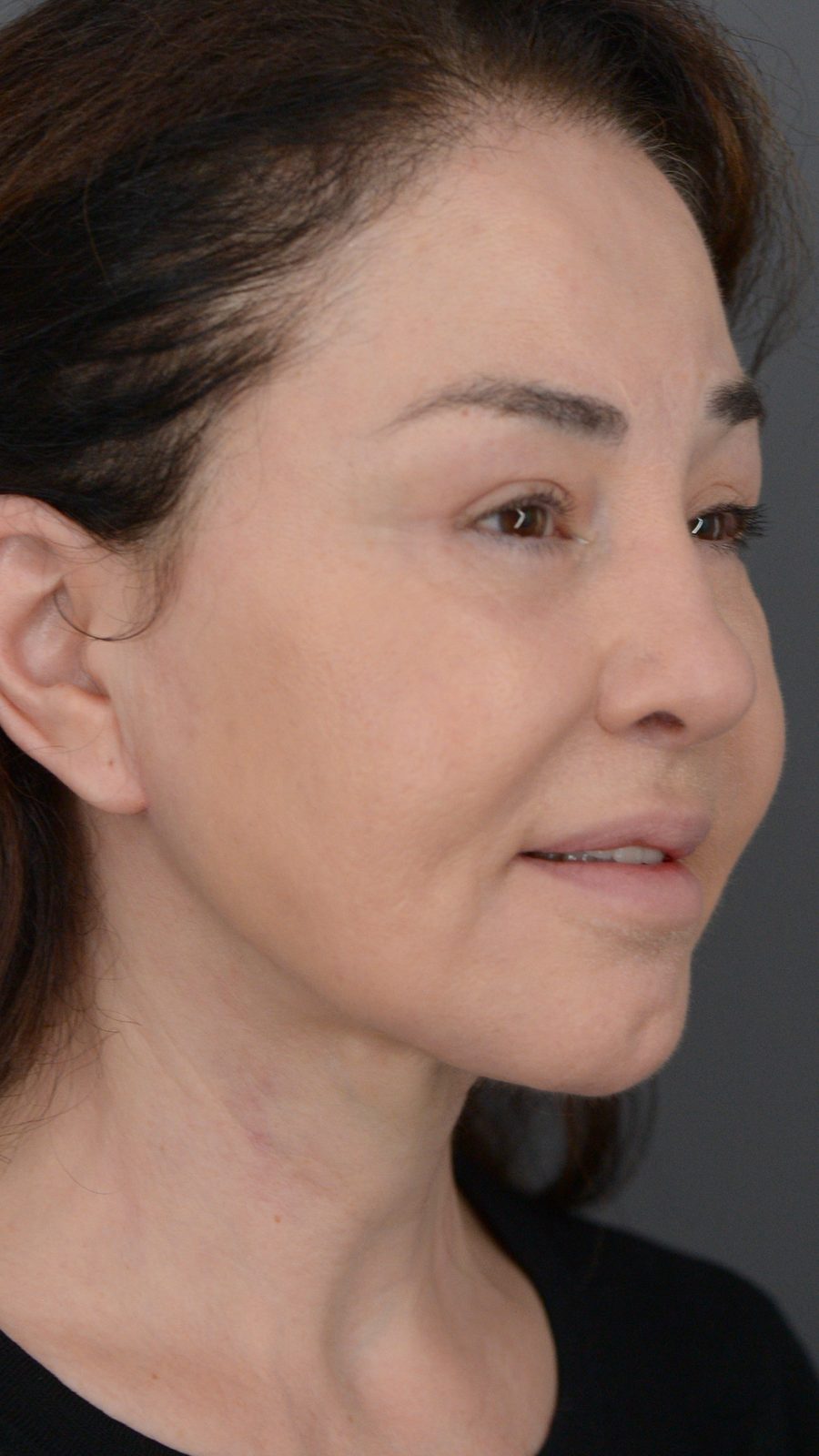 Ponytail Facelift before and after, case 02, view 4 (after)