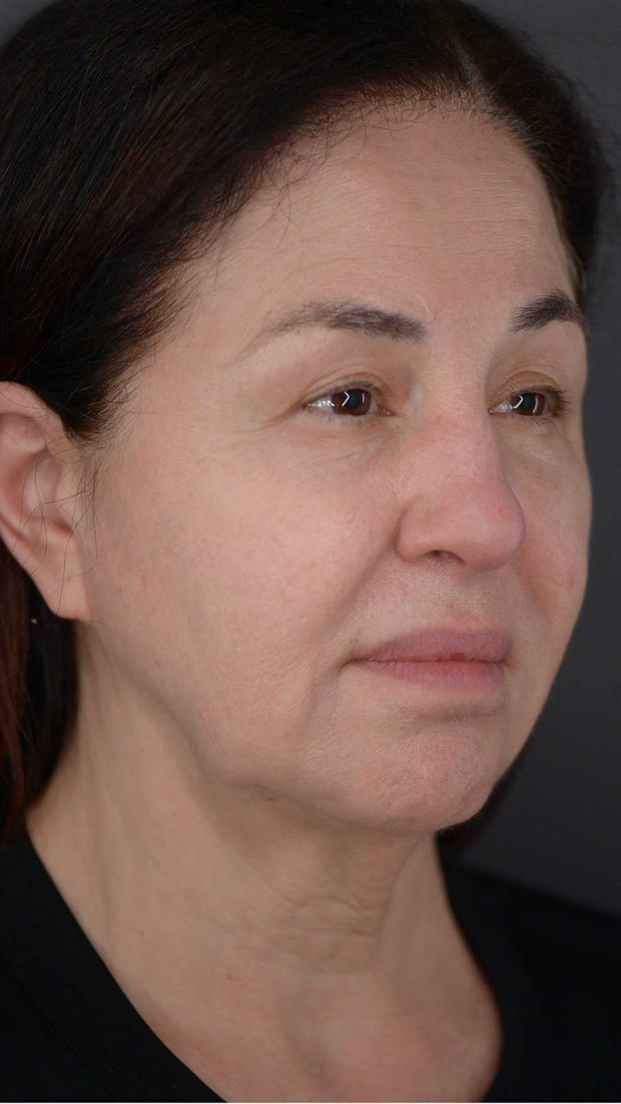 Ponytail Facelift before and after, case 02, view 4 (before)