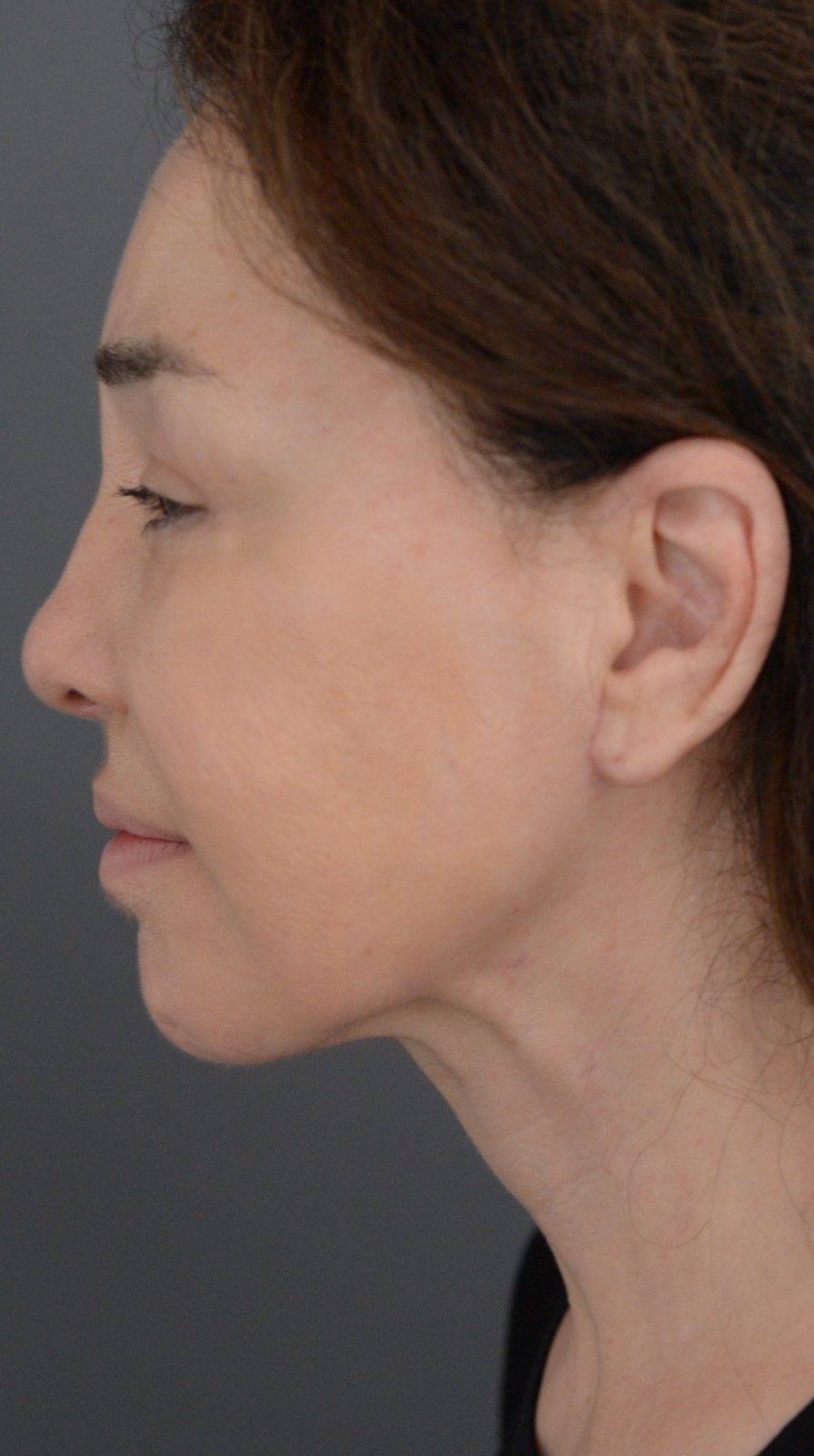 Ponytail Facelift before and after, case 02, view 5 (after)