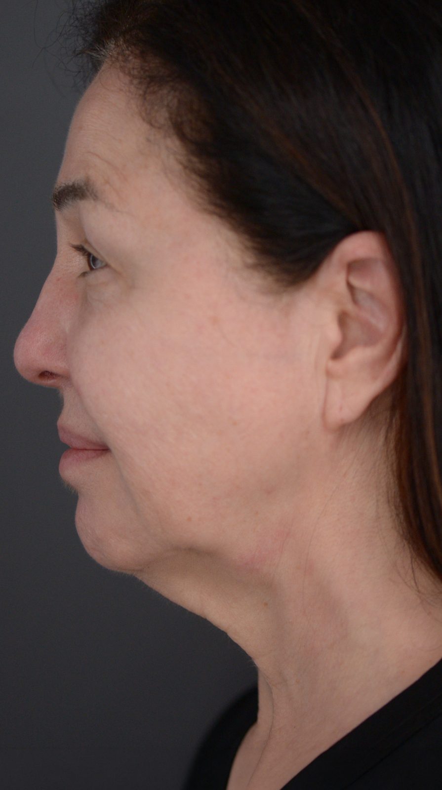 Ponytail Facelift before and after, case 02, view 5 (before)