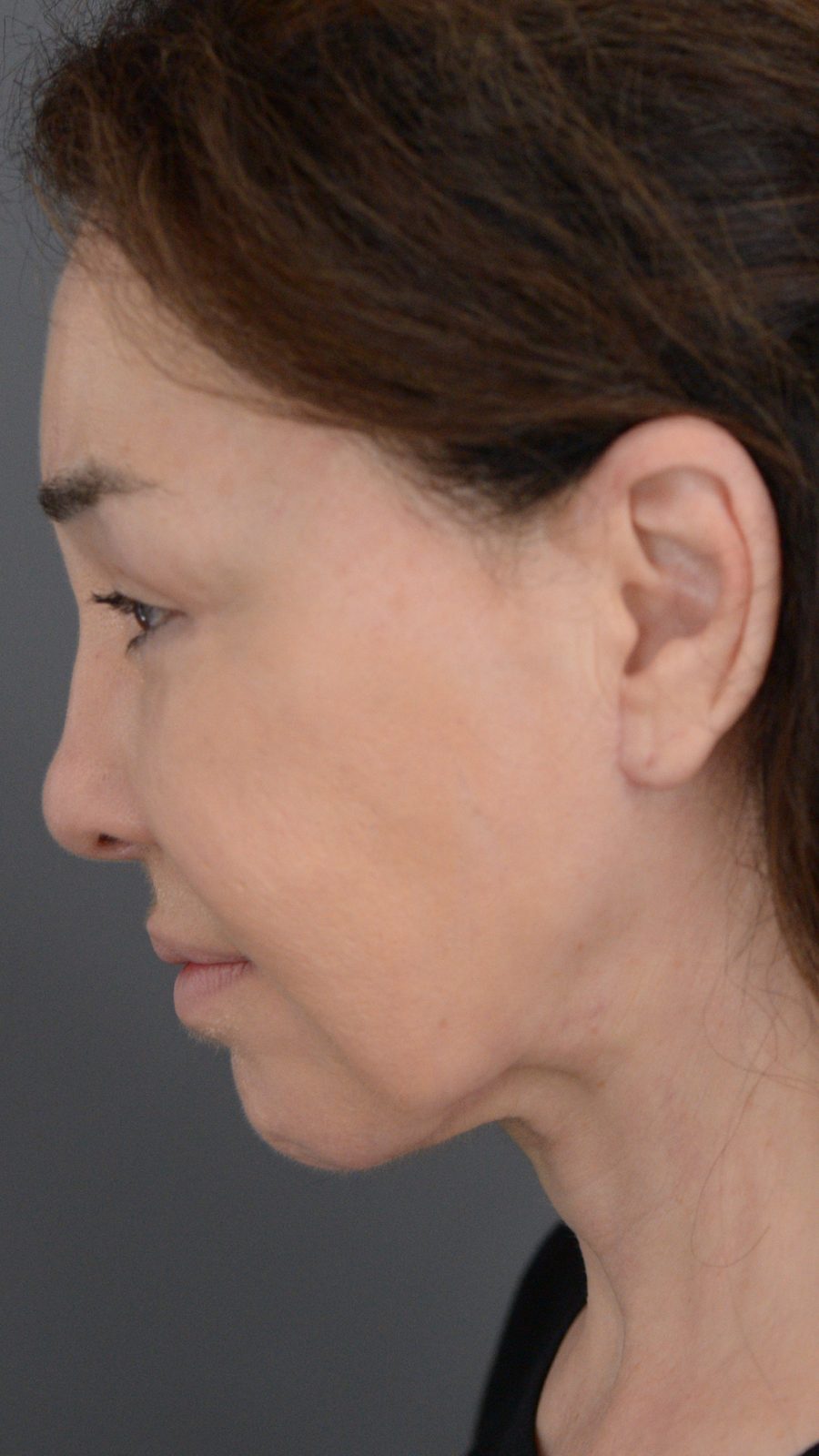 Ponytail Facelift before and after, case 02, view 6 (after)
