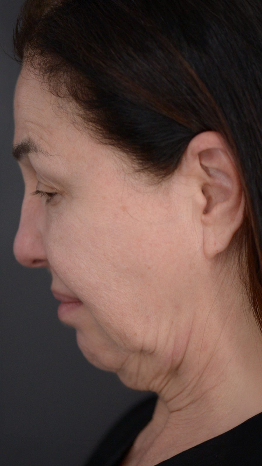 Ponytail Facelift before and after, case 02, view 6 (before)