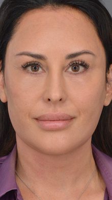 Ponytail Facelift before and after, case 03 (after)