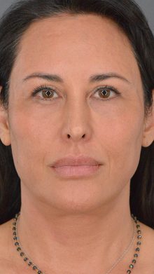 Ponytail Facelift before and after, case 03 (before)