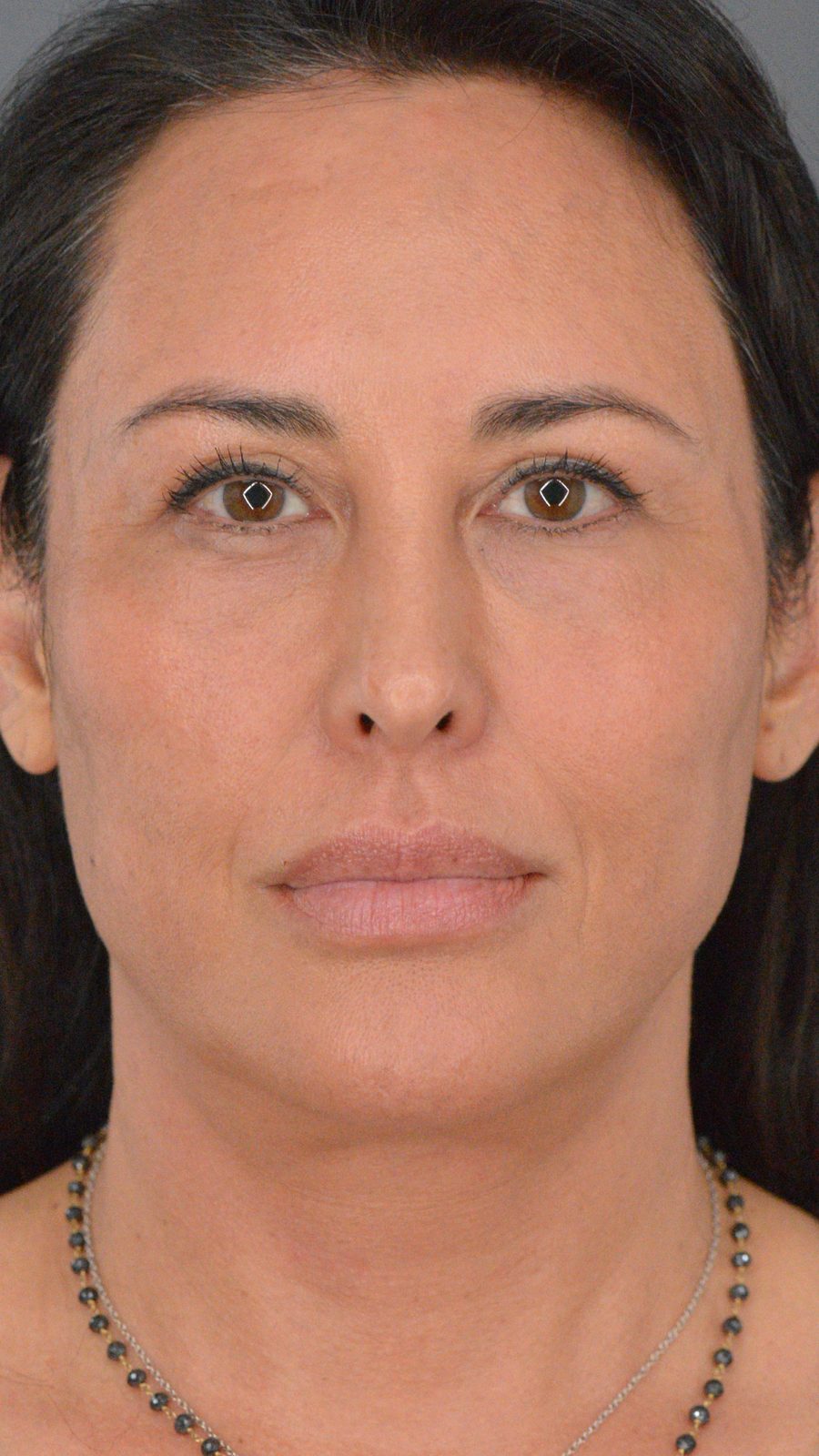 Ponytail Facelift before, case 03