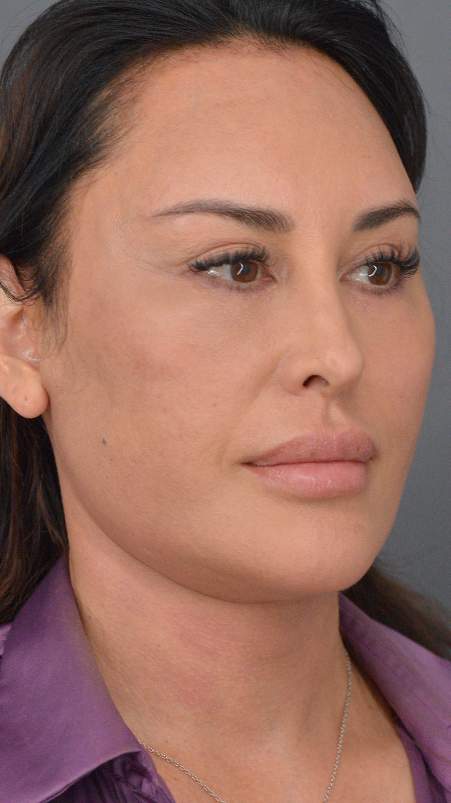 Ponytail Facelift before and after, case 03, view 3 (after)