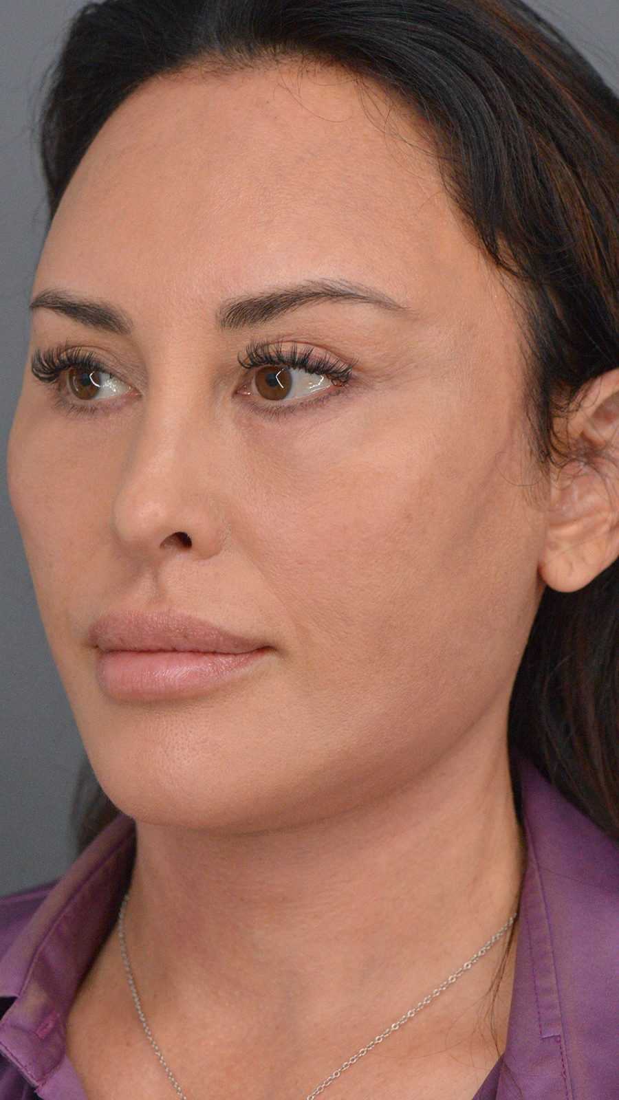 Ponytail Facelift before and after, case 03, view 4 (after)