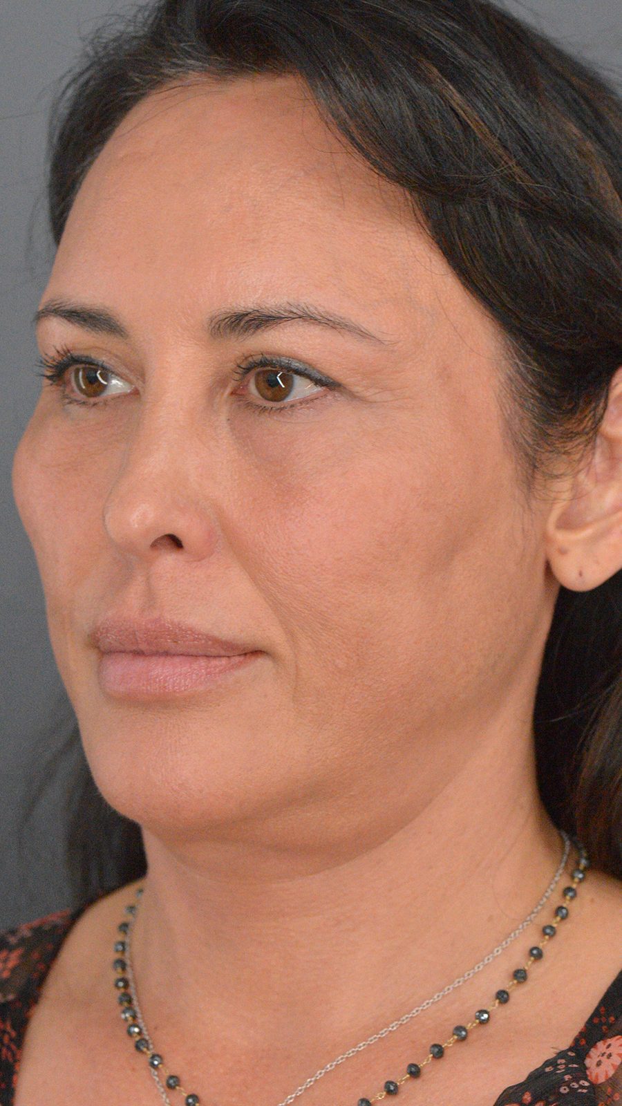 Ponytail Facelift before and after, case 03, view 4 (before)