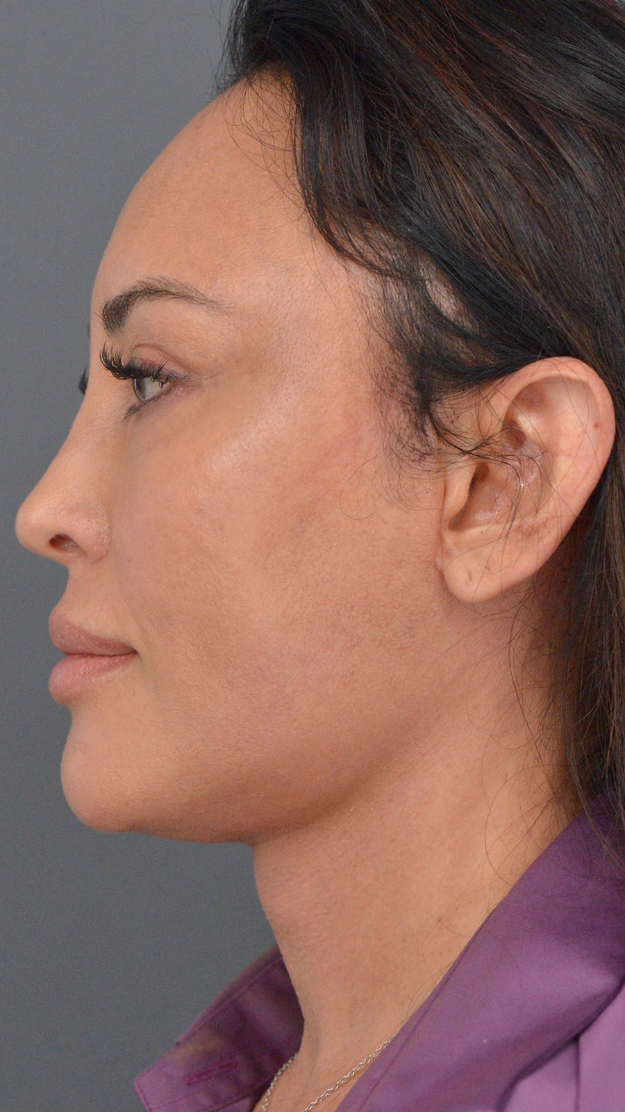 Ponytail Facelift before and after, case 03, view 5 (after)