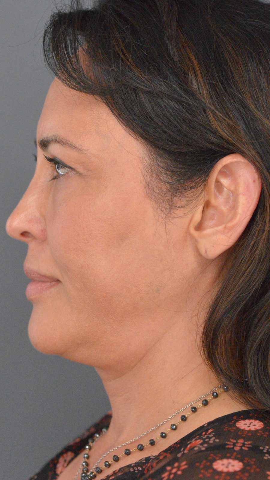 Ponytail Facelift before and after, case 03, view 5 (before)