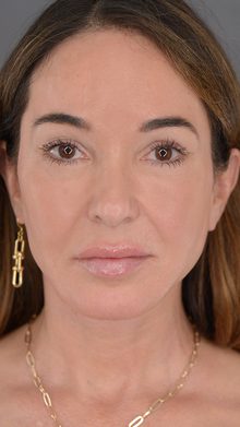 Ponytail Facelift before and after, case 04 (after)