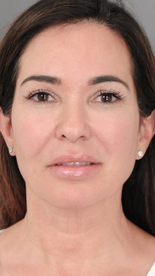 Ponytail Facelift before and after, case 04 (before)