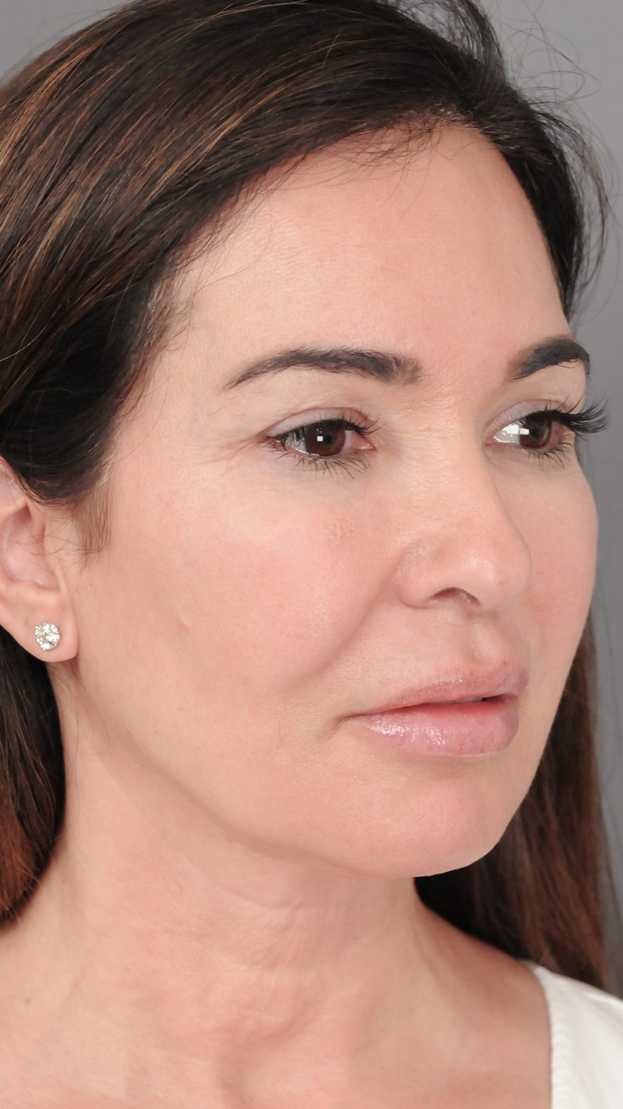 Ponytail Facelift before and after, case 04, view 3 (before)