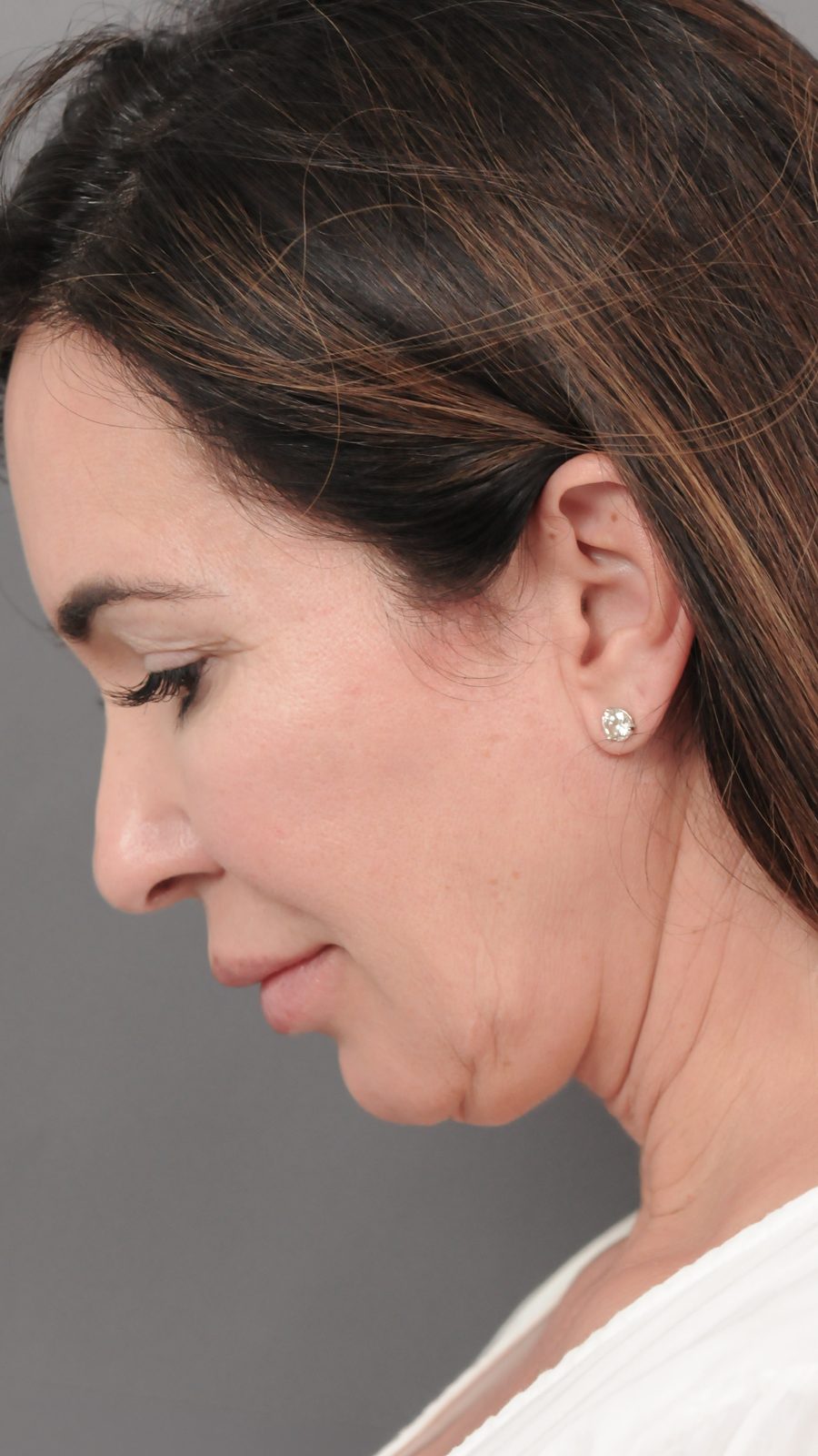 Ponytail Facelift before and after, case 04, view 4 (before)