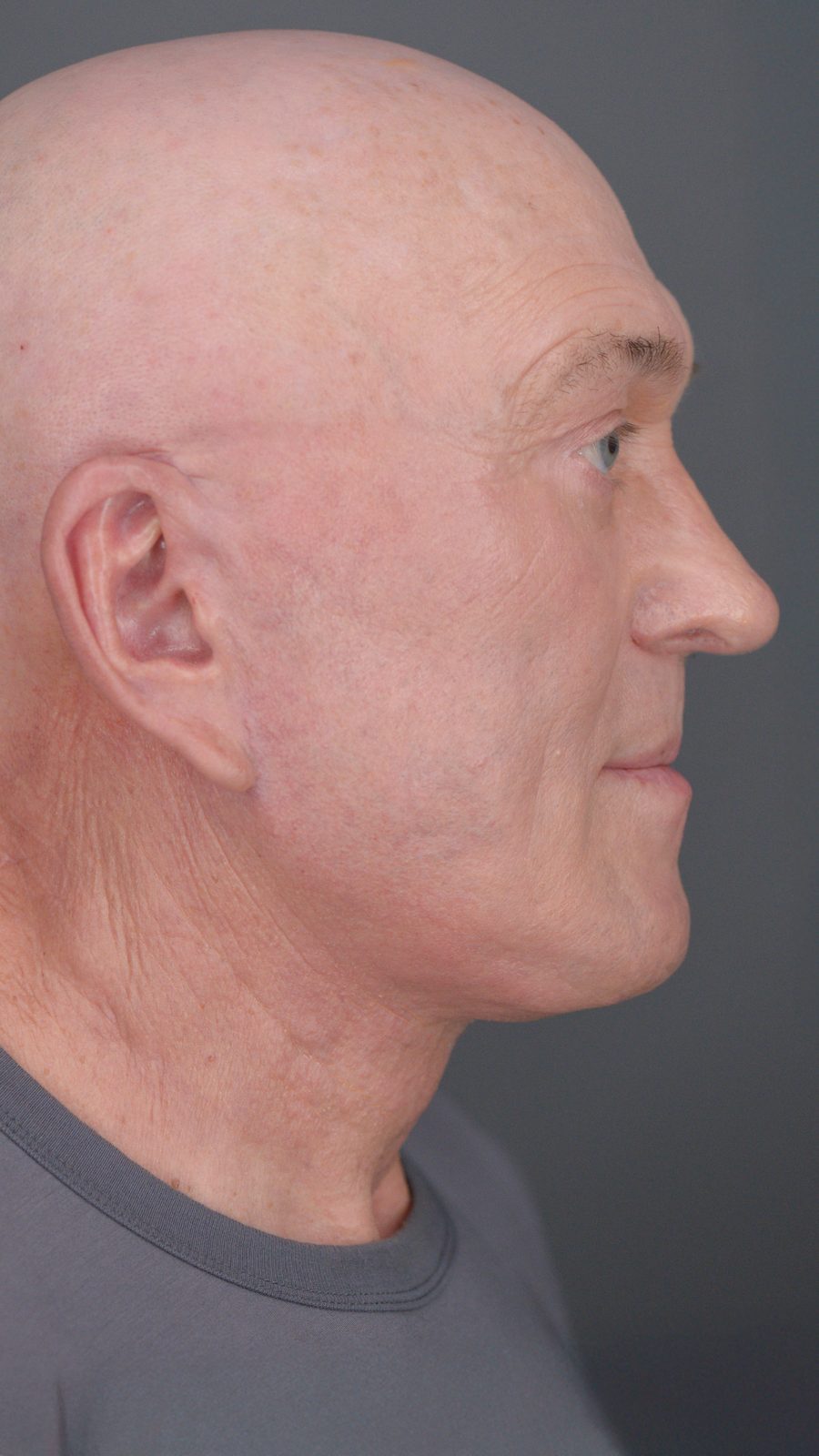 Ponytail Facelift before and after, case 05, view 6 (after)