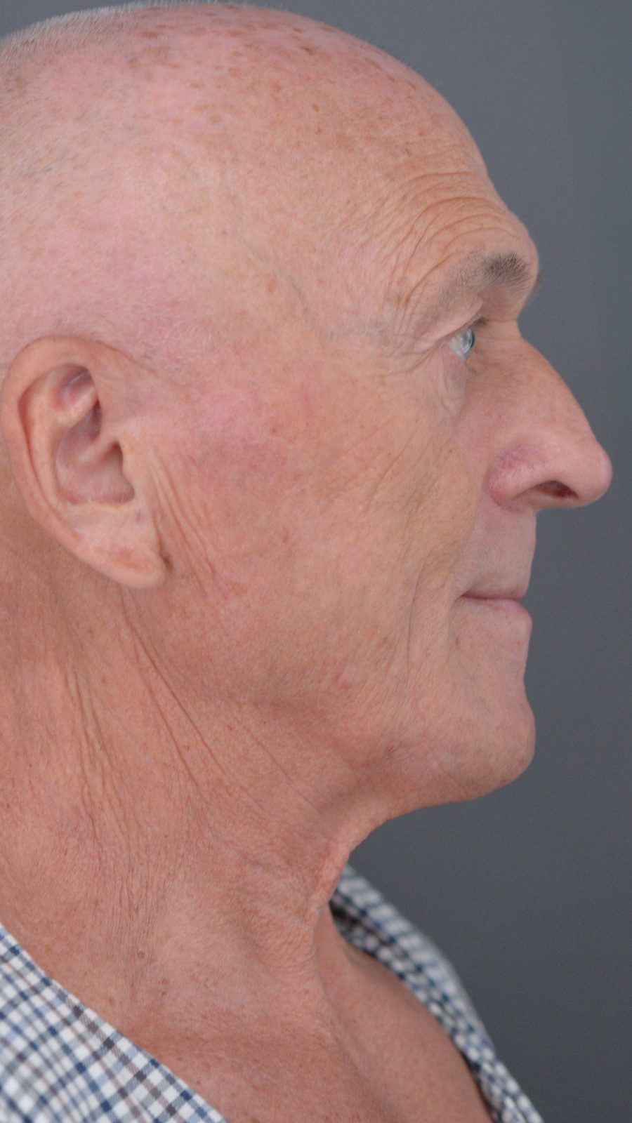 Ponytail Facelift before and after, case 05, view 6 (before)