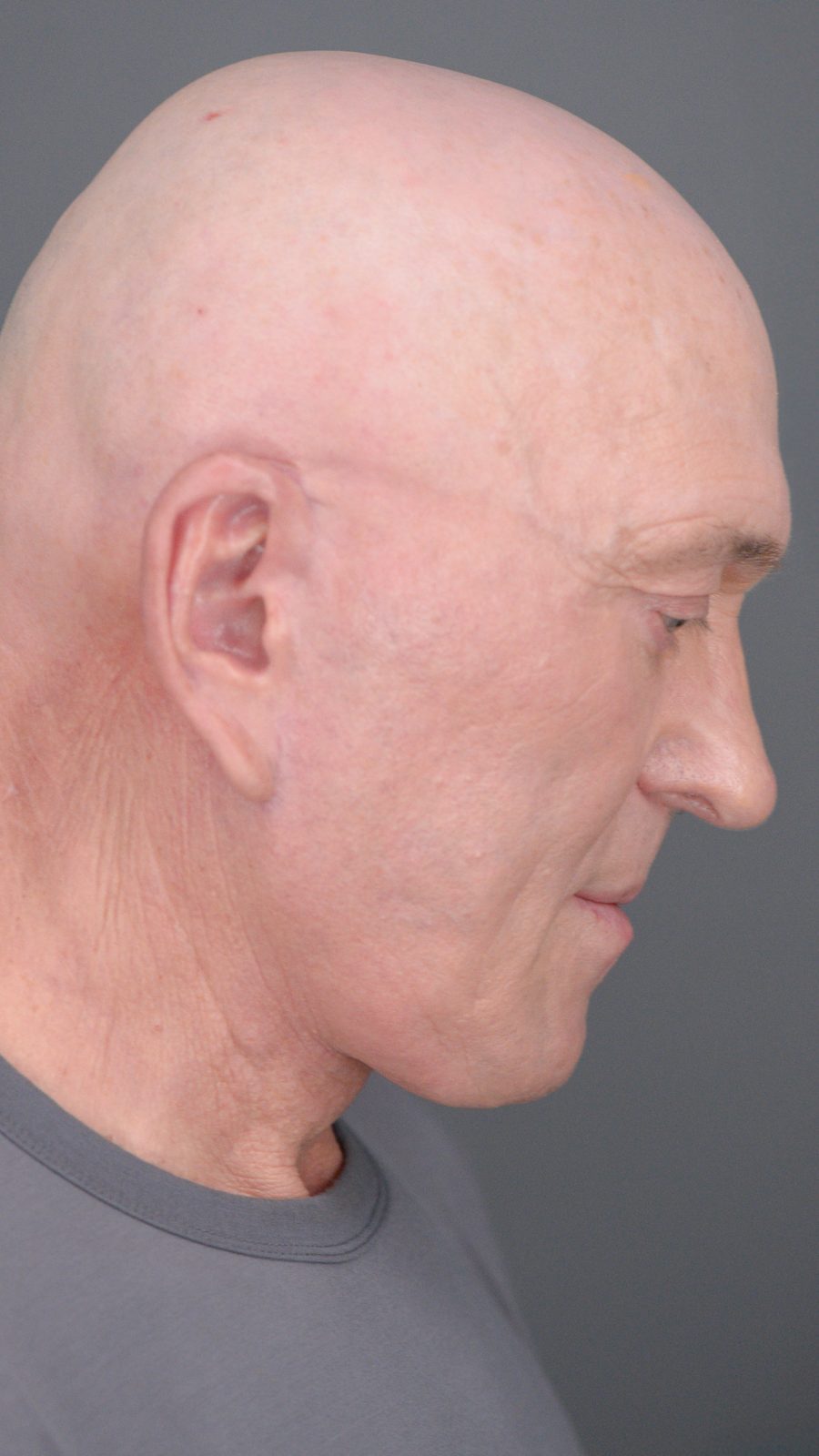 Ponytail Facelift before and after, case 05, view 7 (after)