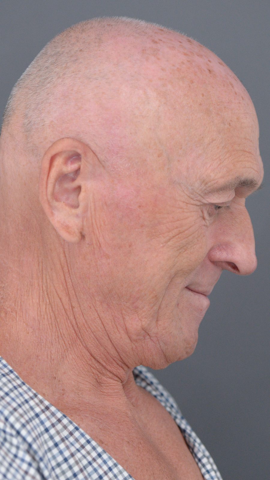 Ponytail Facelift before and after, case 05, view 7 (before)