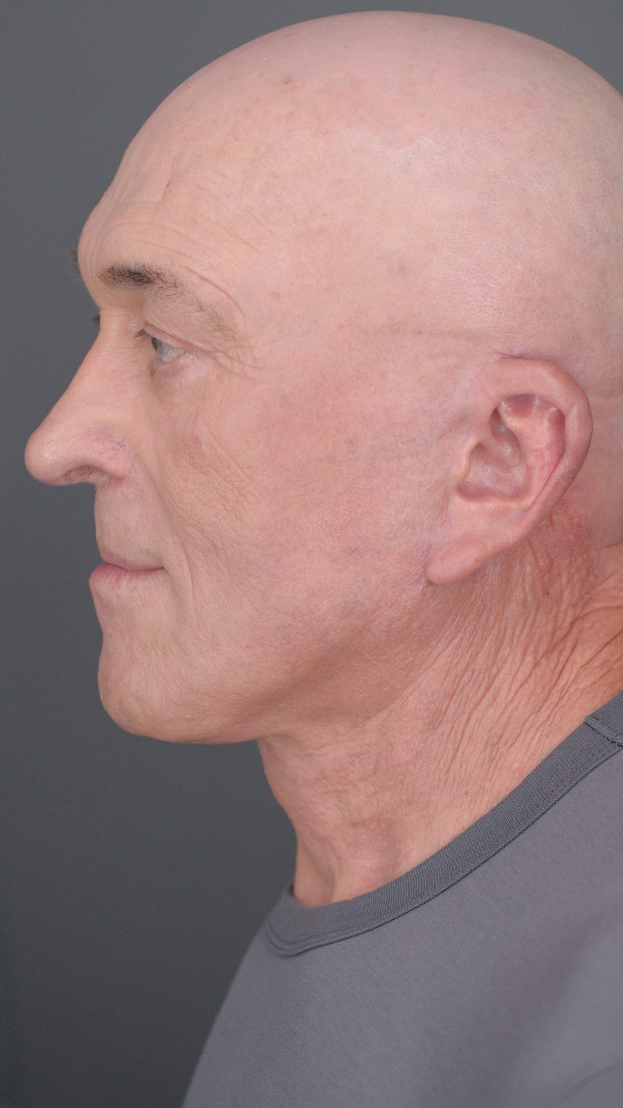 Ponytail Facelift before and after, case 05, view 8 (after)