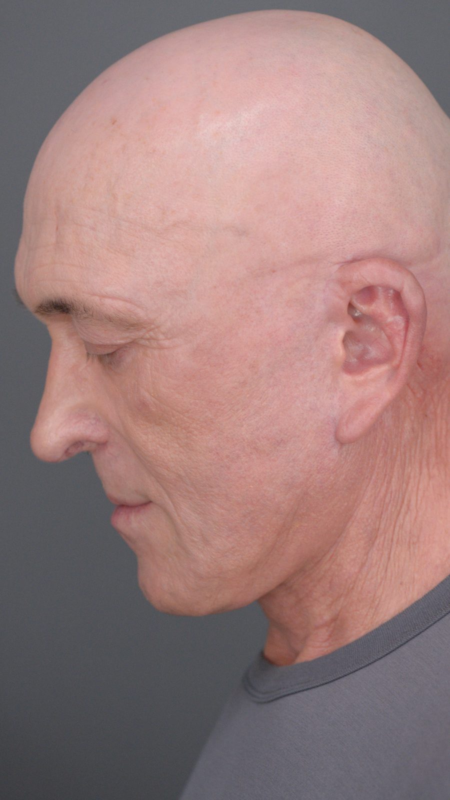 Ponytail Facelift before and after, case 05, view 9 (after)