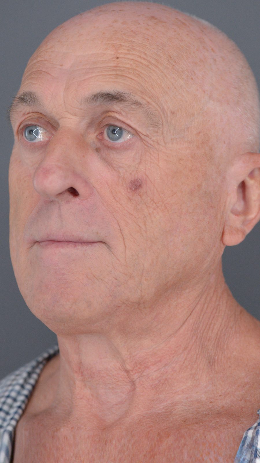 Ponytail Facelift before and after, case 05, view 9 (before)