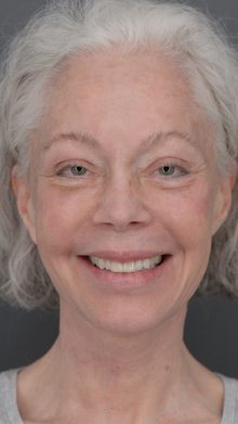 Ponytail Facelift before and after, case 06 (after)