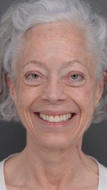 Ponytail Facelift before and after, case 06 (before)
