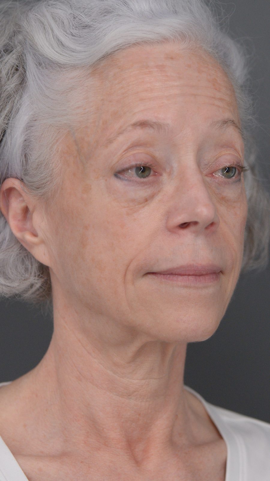 Ponytail Facelift before and after, case 06, view 3 (before)