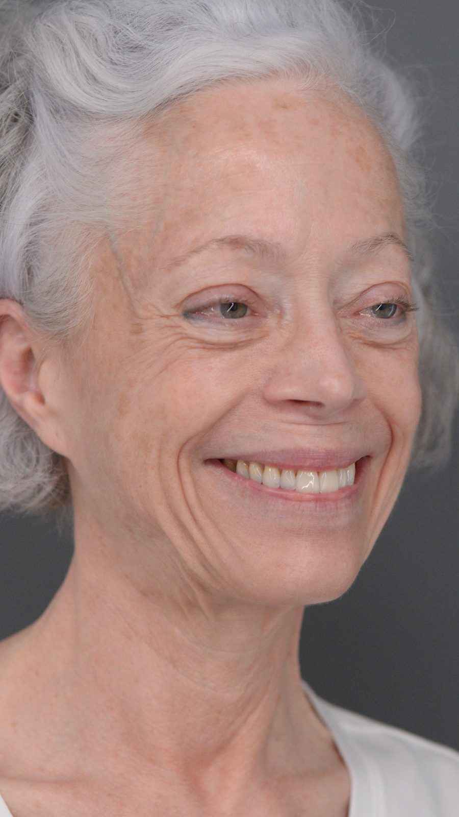 Ponytail Facelift before and after, case 06, view 4 (before)