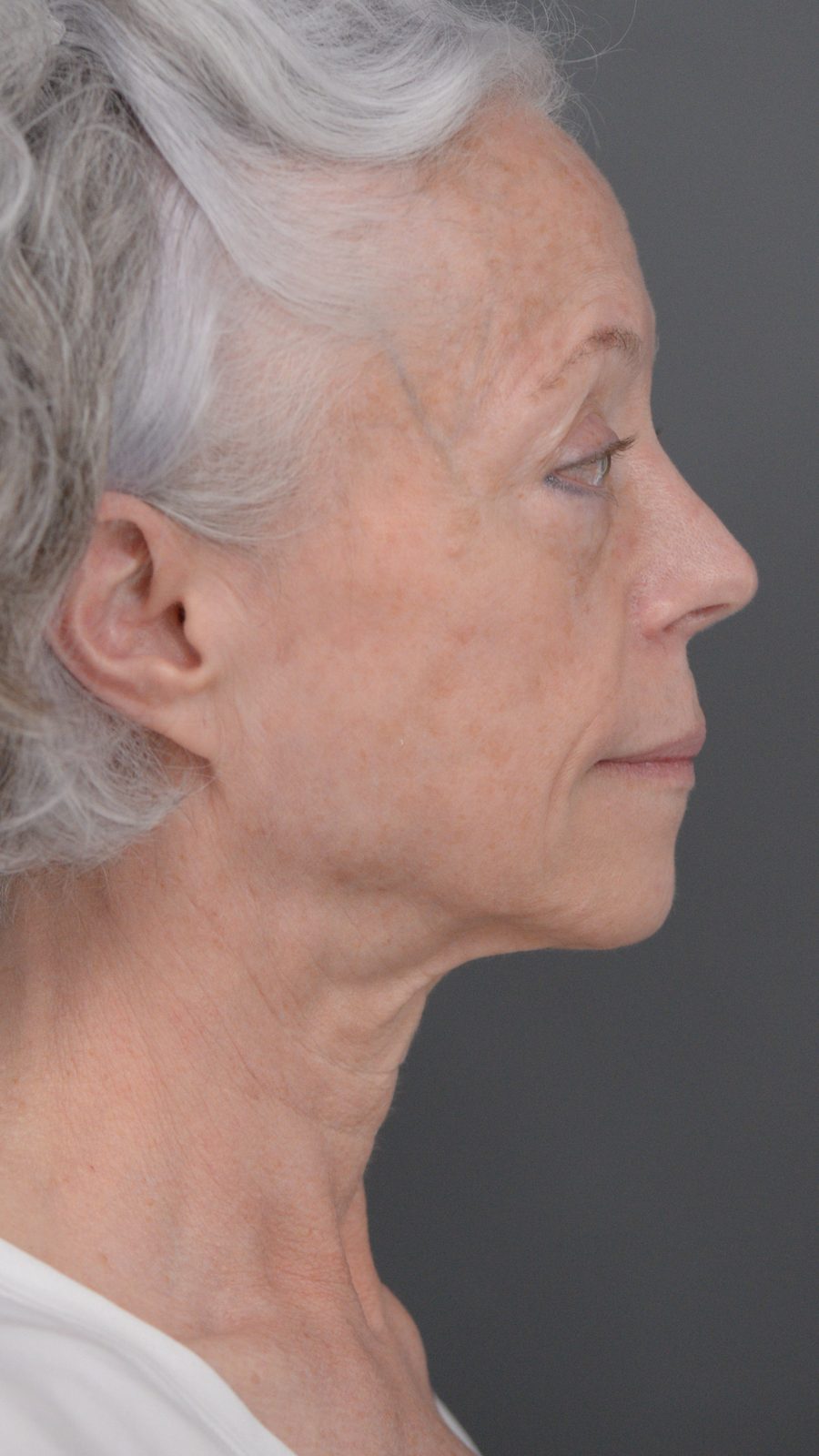 Ponytail Facelift before and after, case 06, view 5 (before)