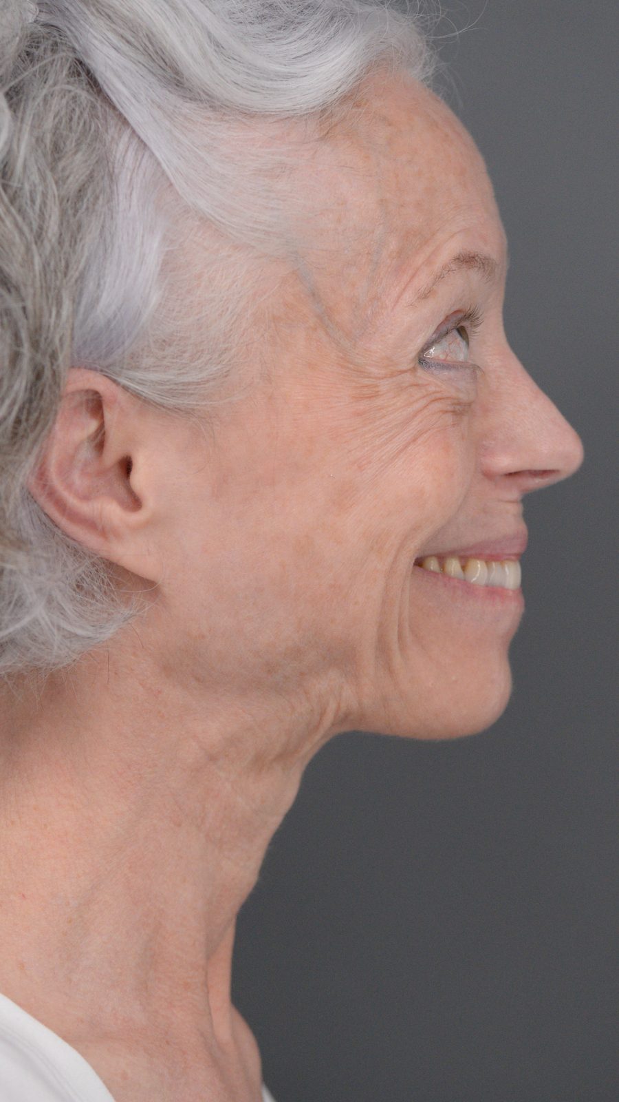 Ponytail Facelift before and after, case 06, view 6 (before)