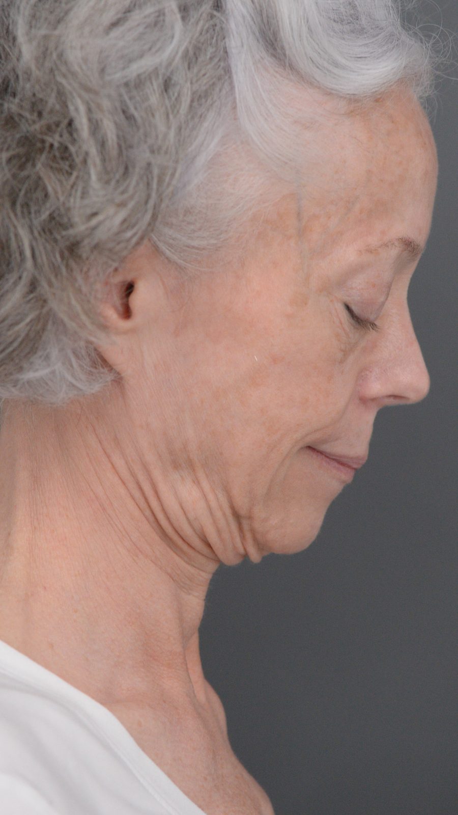 Ponytail Facelift before and after, case 06, view 7 (before)