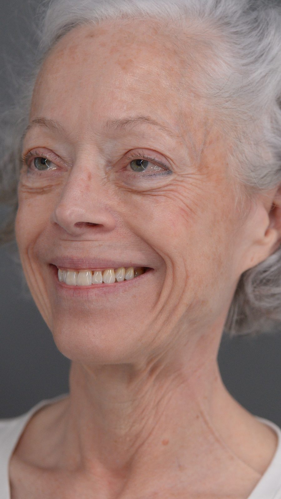 Ponytail Facelift before and after, case 06, view 8 (before)