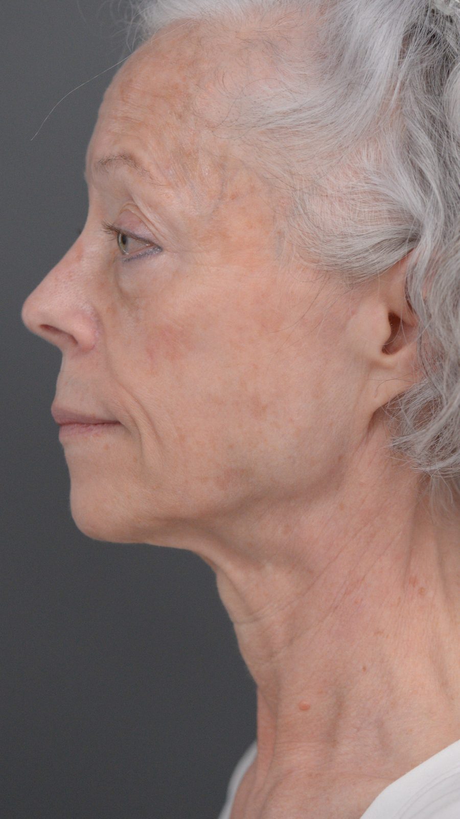 Ponytail Facelift before and after, case 06, view 9 (before)
