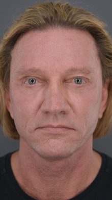 Ponytail Facelift before and after, case 07 (after)