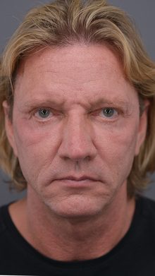 Ponytail Facelift before and after, case 07 (before)