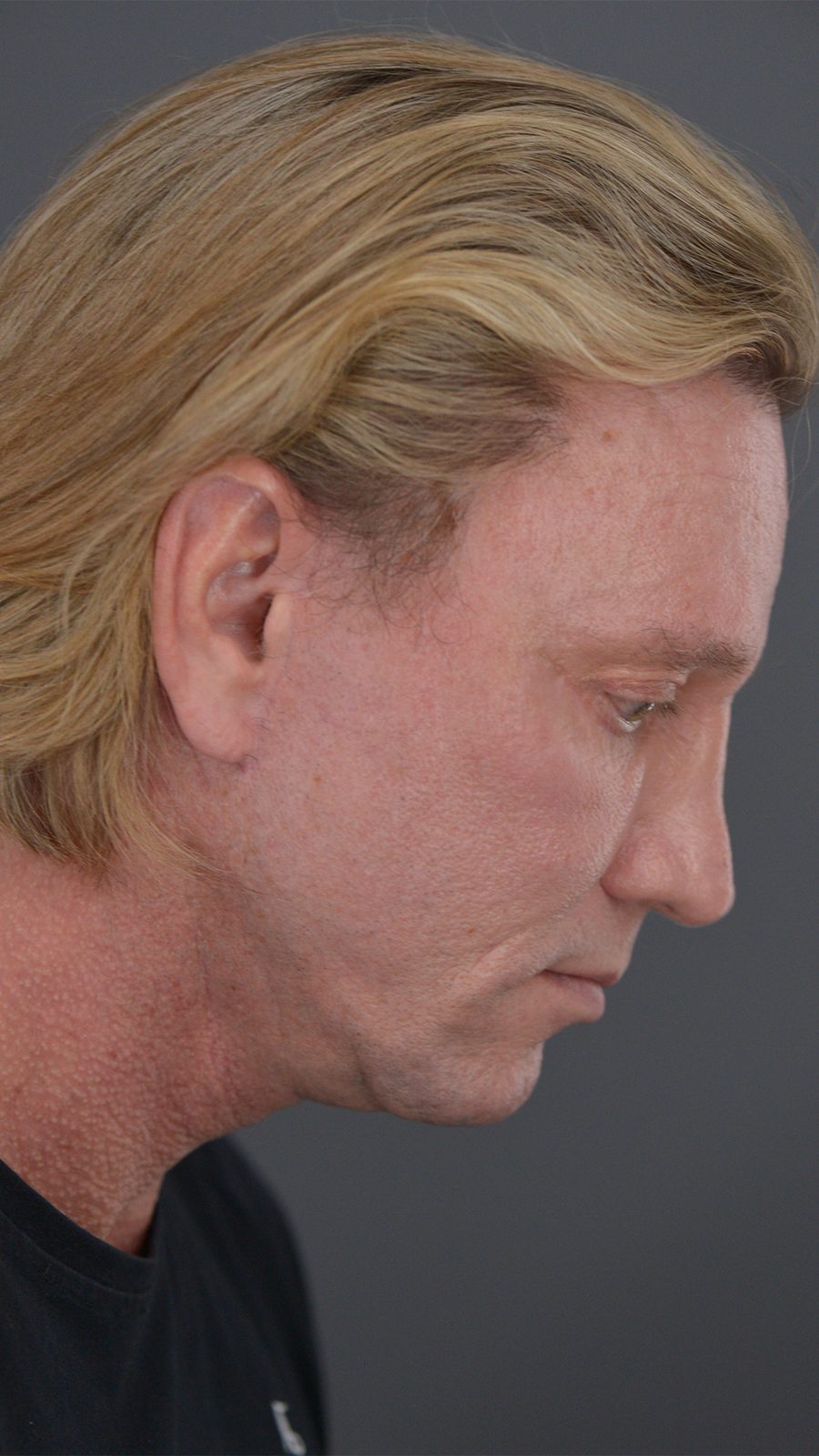 Ponytail Facelift before and after, case 07, view 3 (after)