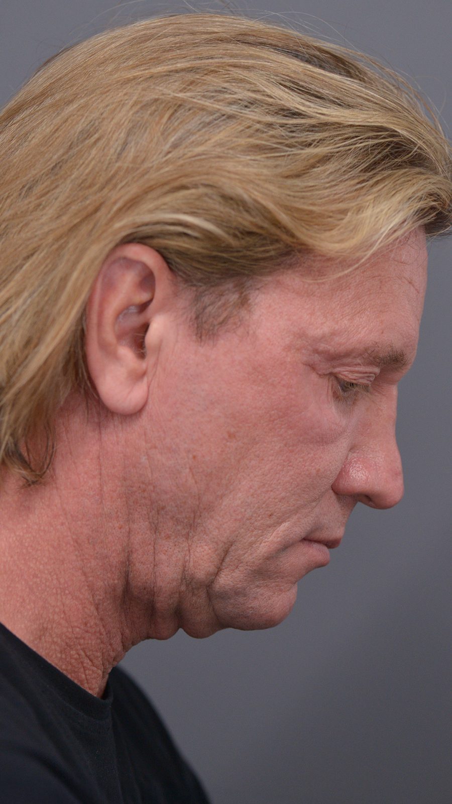 Ponytail Facelift before and after, case 07, view 3 (before)