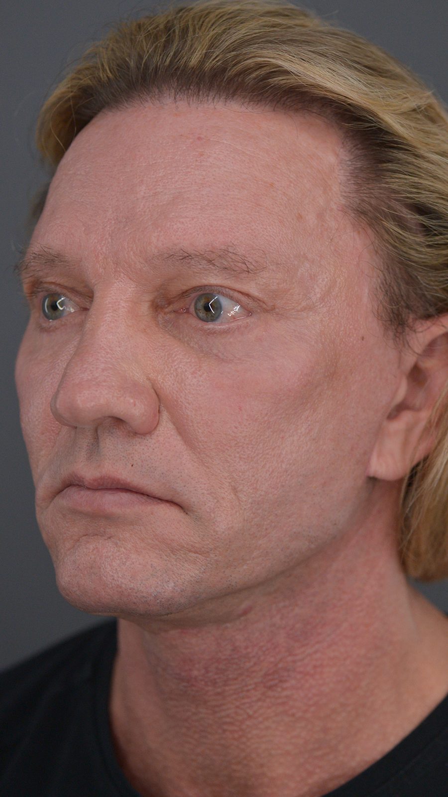 Ponytail Facelift before and after, case 07, view 4 (after)