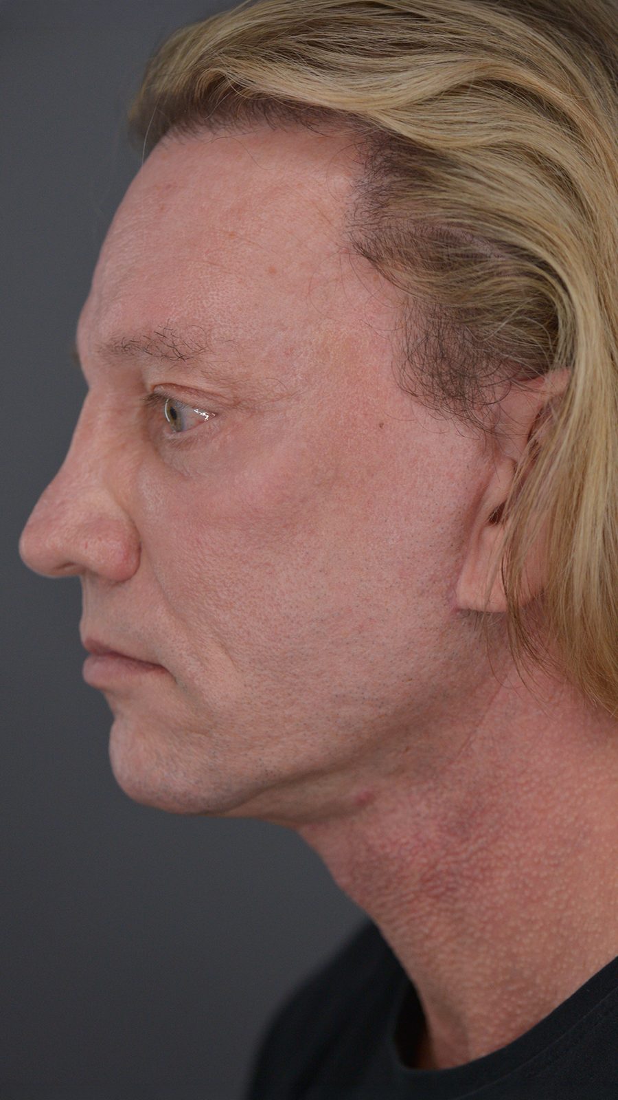 Ponytail Facelift before and after, case 07, view 5 (after)