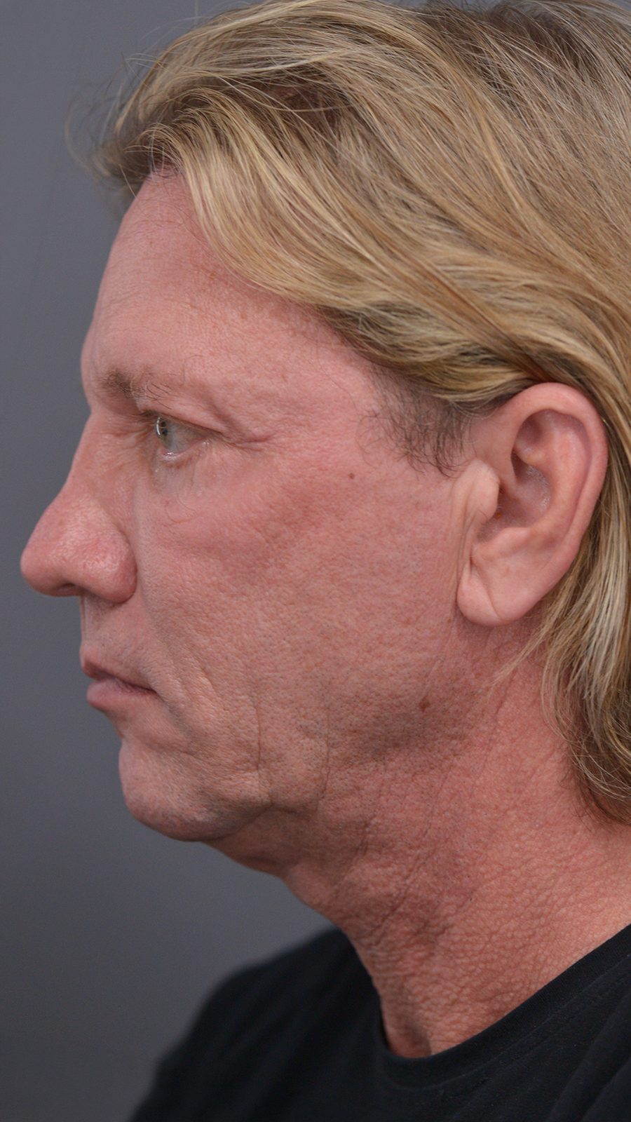Ponytail Facelift before and after, case 07, view 5 (before)