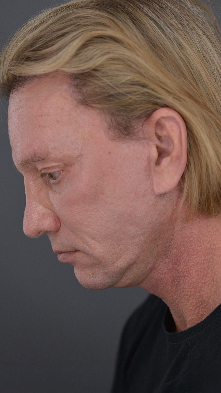 Ponytail Facelift before and after, case 07, view 6 (after)