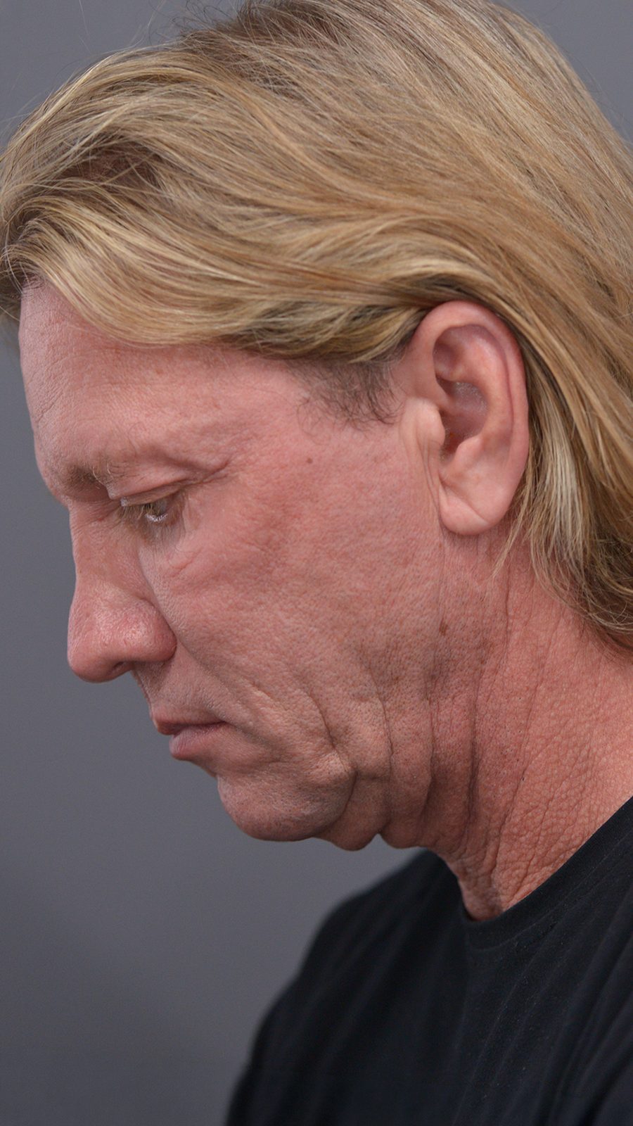 Ponytail Facelift before and after, case 07, view 6 (before)