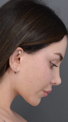 Ponytail Facelift before and after, case 08 (after)