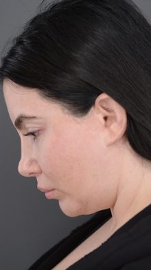 Ponytail Facelift before and after, case 08 (before)