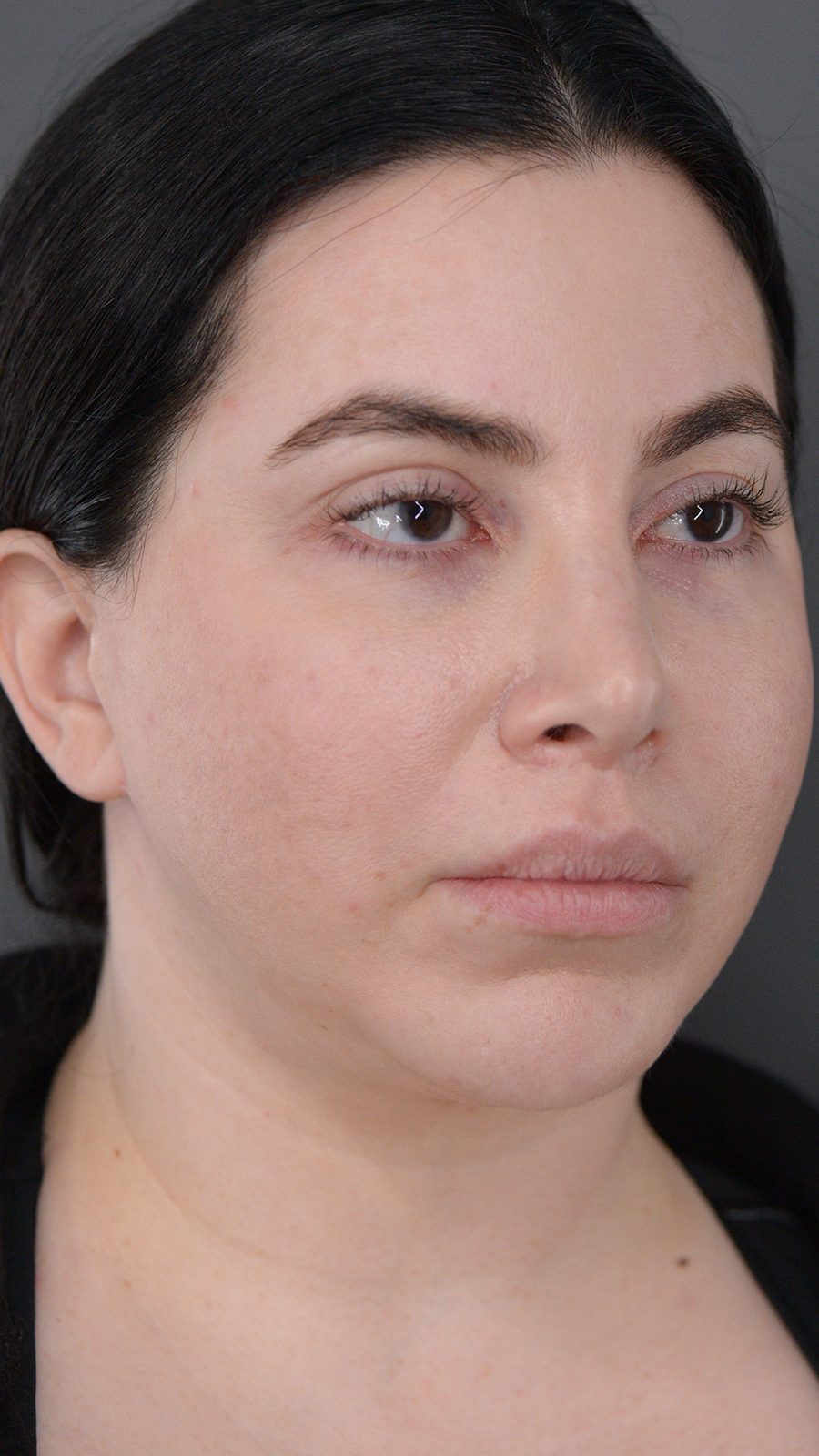 Ponytail Facelift before and after, case 08, view 5 (before)