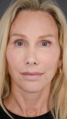 Ponytail Facelift before and after, case 09 (after)