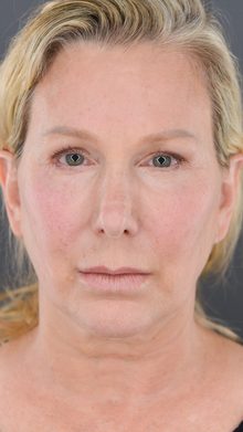 Ponytail Facelift before and after, case 09 (before)