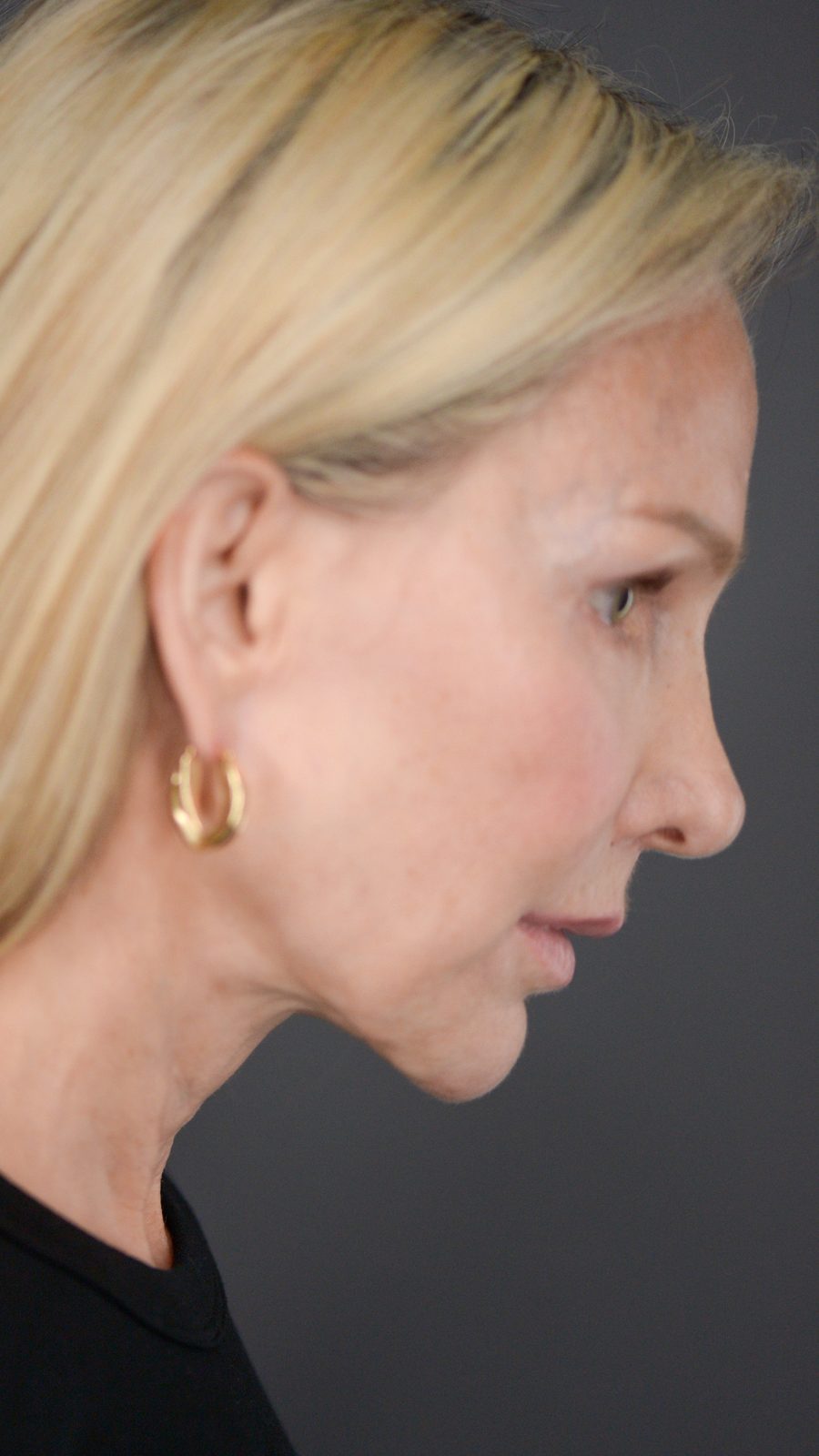 Ponytail Facelift before and after, case 09, view 3 (after)
